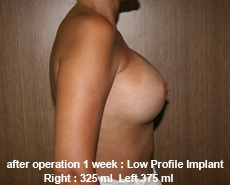 plastic-surgery-breast-augmentation